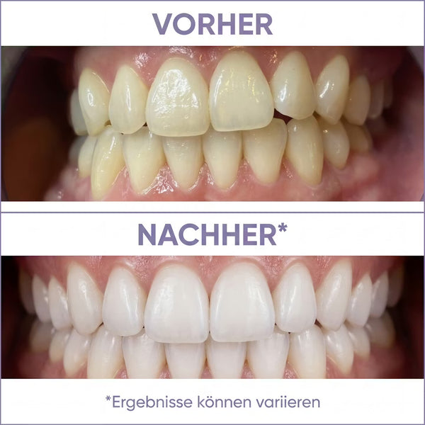 Smile Dentol Pro Whitening Strips